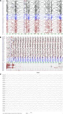 Non-convulsive Status Epilepticus in SEMA6B-Related Progressive Myoclonic Epilepsy: A Case Report With Literature Review